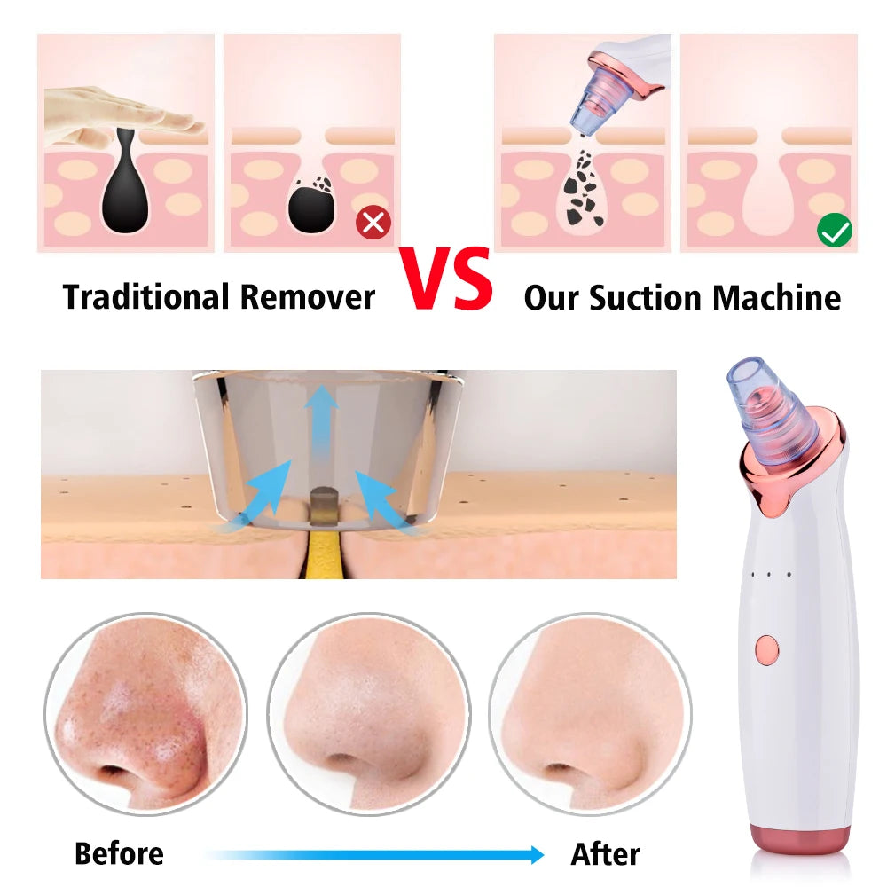 PorePerfection™ Vacuum Cleanser